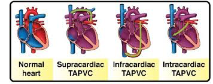 Total Anomalous Pulmonary Venous Return